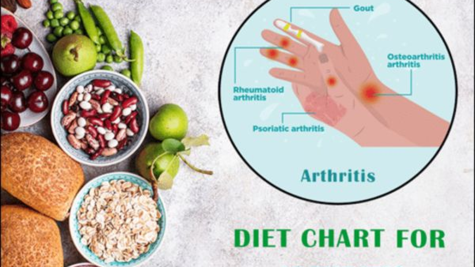 Diet vs Rheumatic Diseases | Patientexperts
